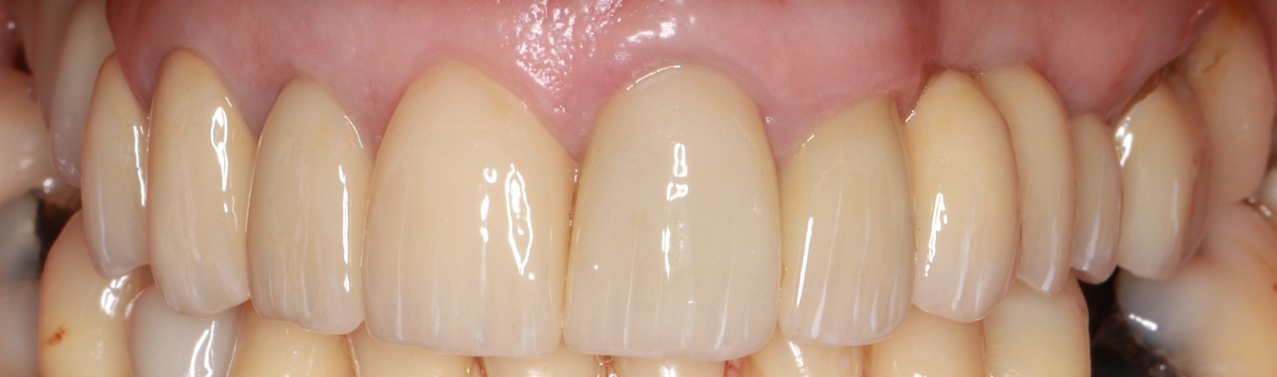 1.Full Mouth Rehabilitation with crowns, bridges and implants After